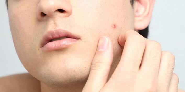 pimples on face removal tips