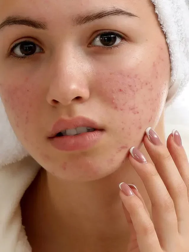 Say Goodbye to Acne Scars