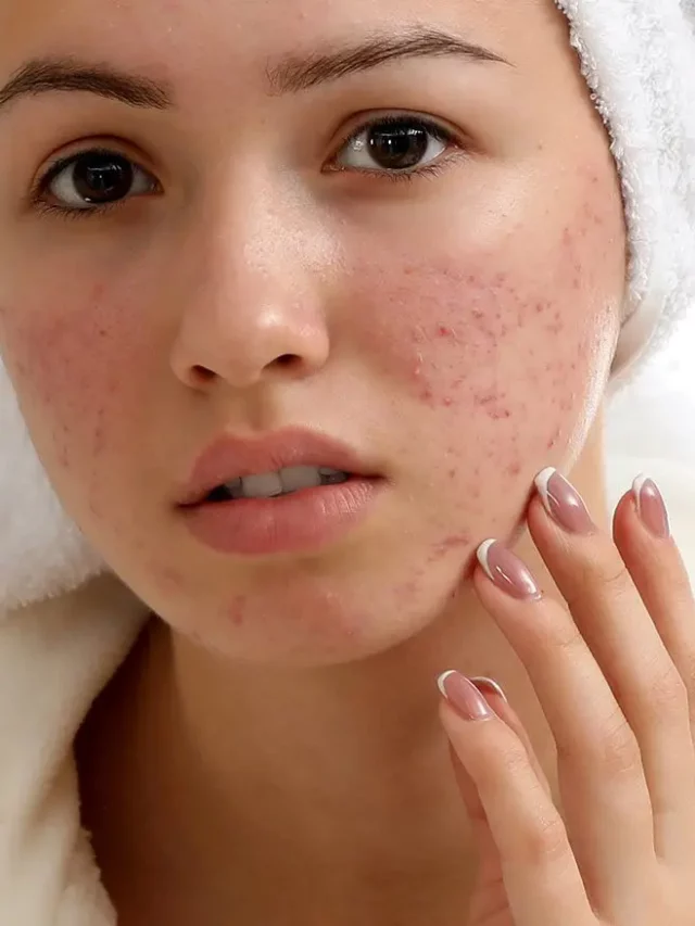 Acne Scars: Types, Causes, Treatments, and Prevention